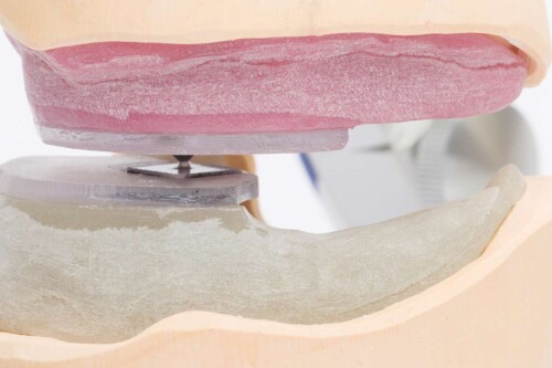 Zentrik Platten System ZPS Laborpackung Baumann Dental